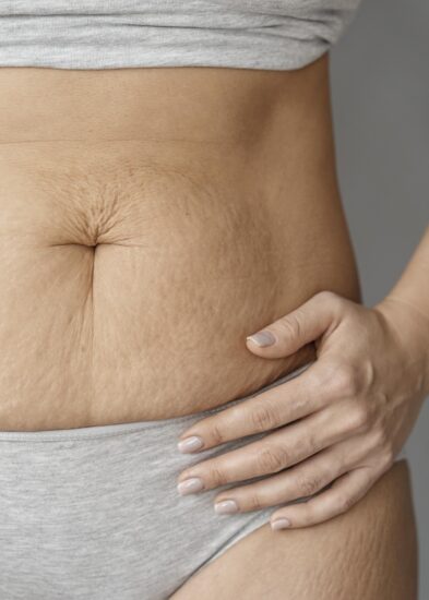 rozstępy w ciąży na całym ciele