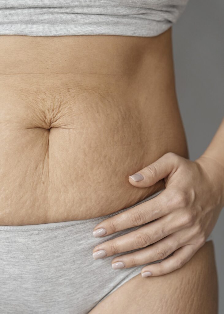 rozstępy w ciąży na całym ciele